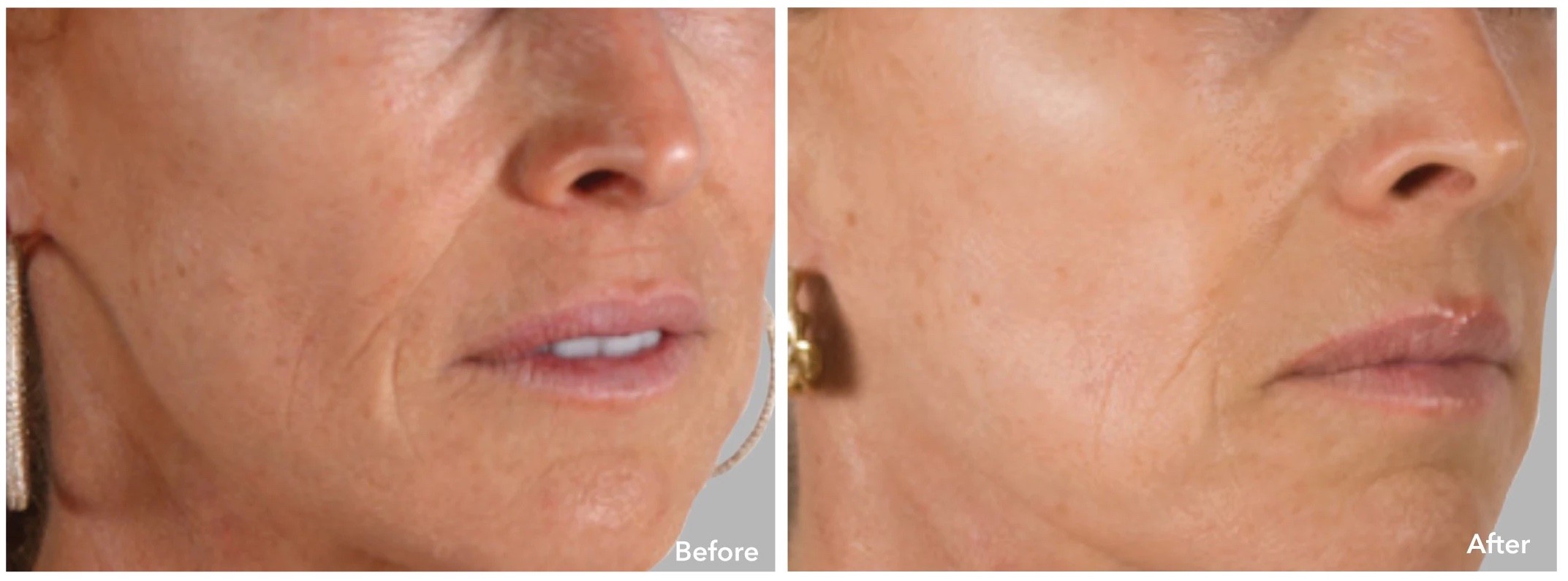 The AnteAGE MD Home Skin Care System can help your skin recover from sun damage.
